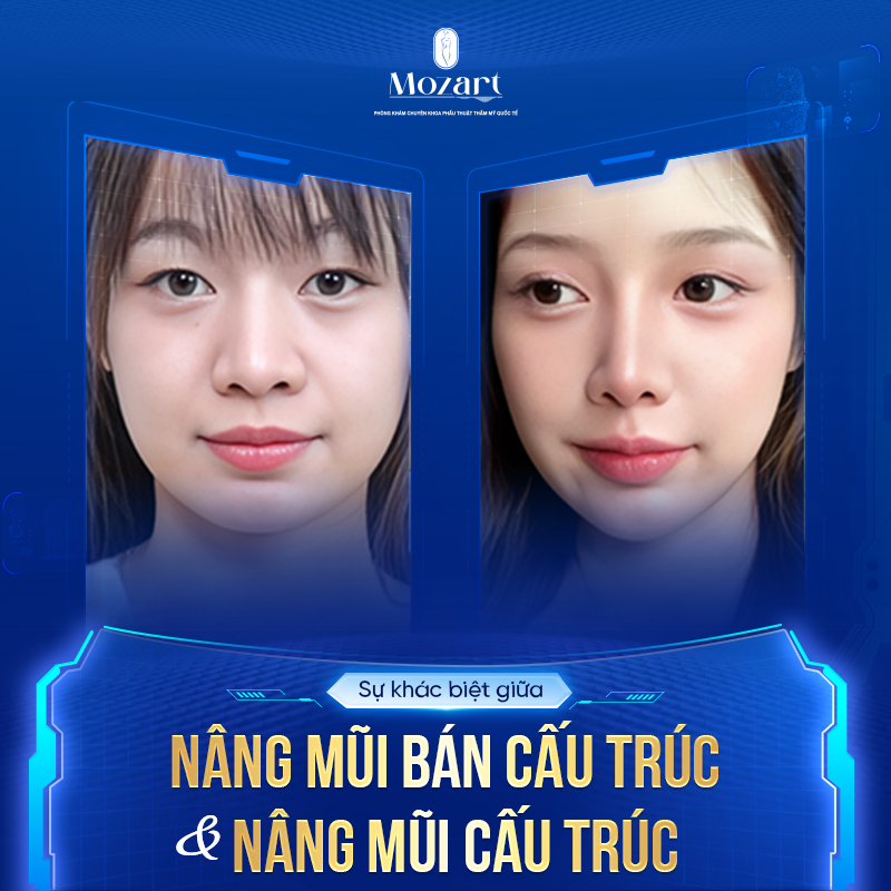 nâng mũi bán cấu trúc