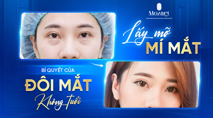 lấy mỡ mí mắt