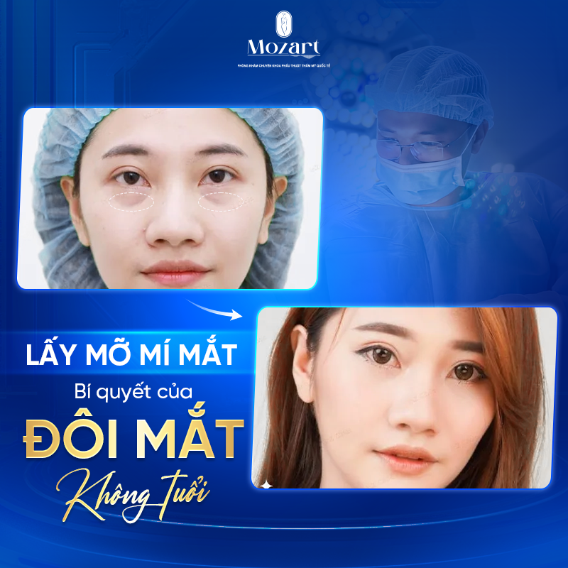 lấy mỡ mí mắt