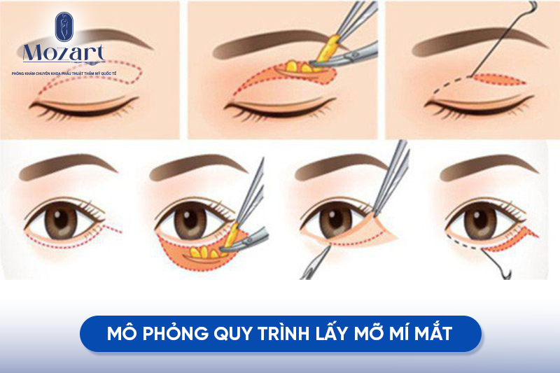 lấy mỡ mí mắt