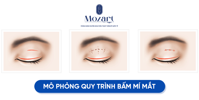 bấm mí Hàn Quốc