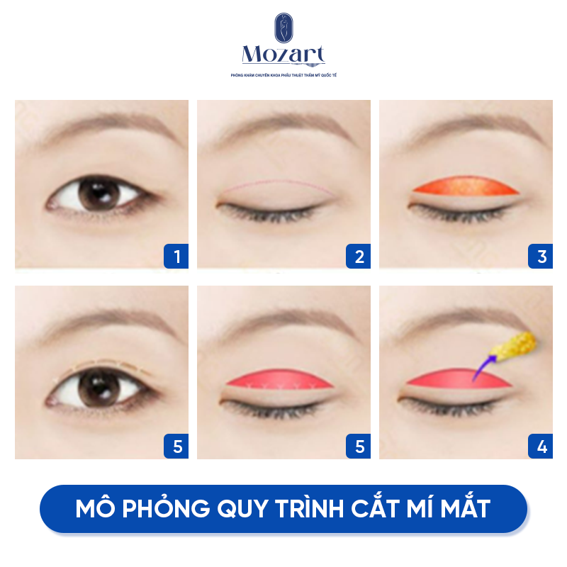 cắt mắt hai mí
