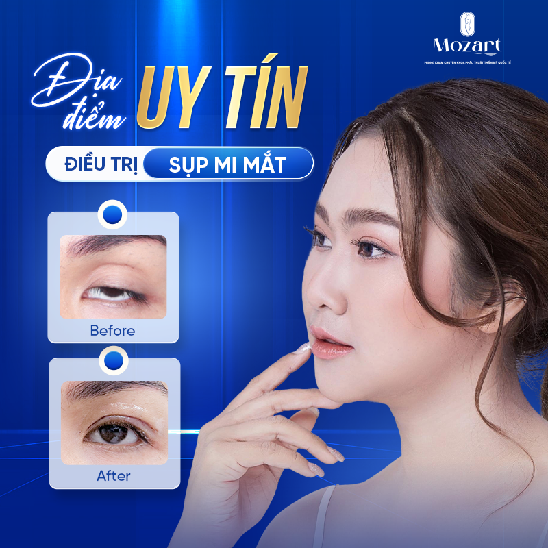 điều trị sụp mi mắt
