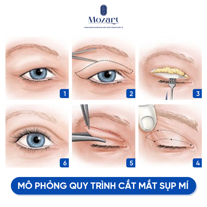 điều trị sụp mi mắt