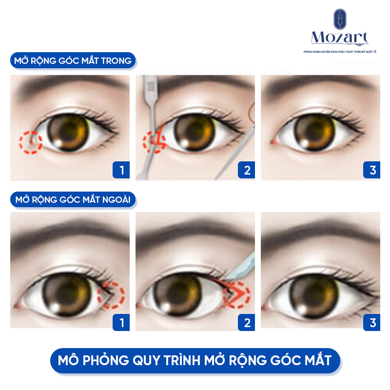 mở rộng góc mắt