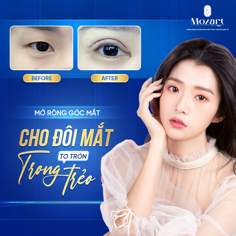 Mở rộng góc mắt