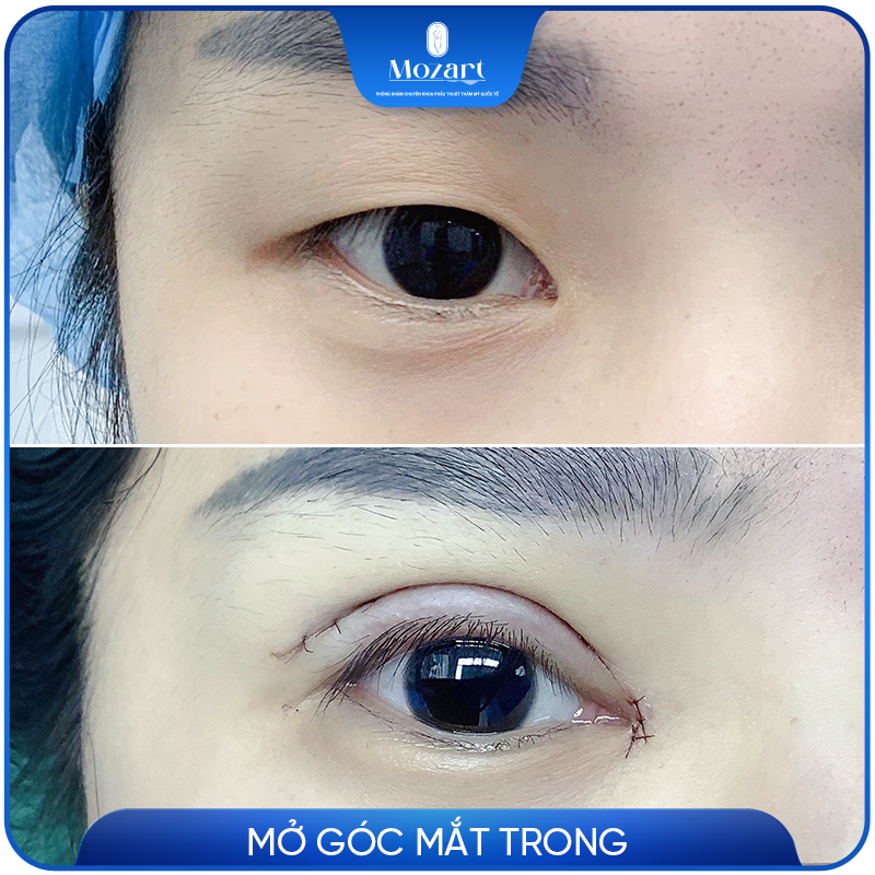 Mở rộng góc mắt