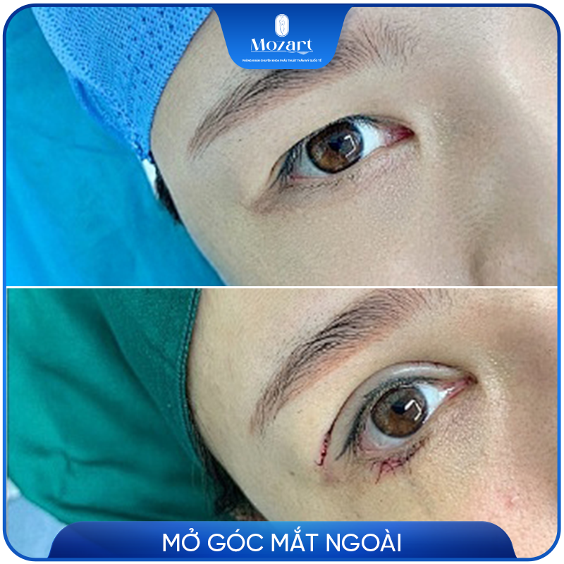 Mở rộng góc mắt