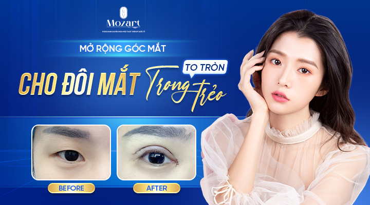 Mở rộng góc mắt