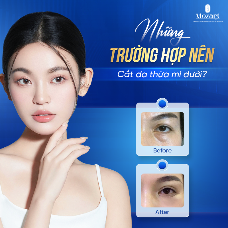 Cắt da thừa mí dưới