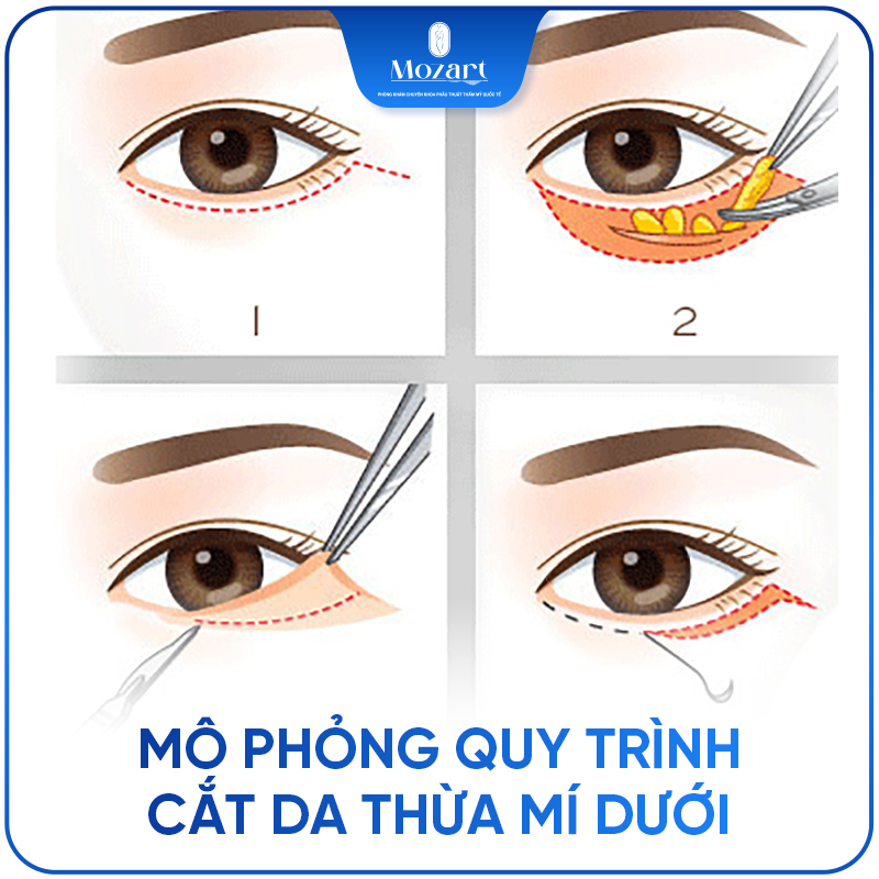 Cắt da thừa mí dưới