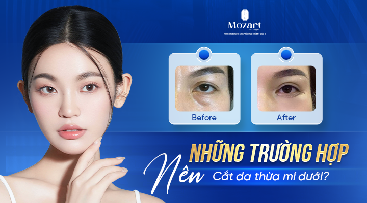 Cắt da thừa mí dưới