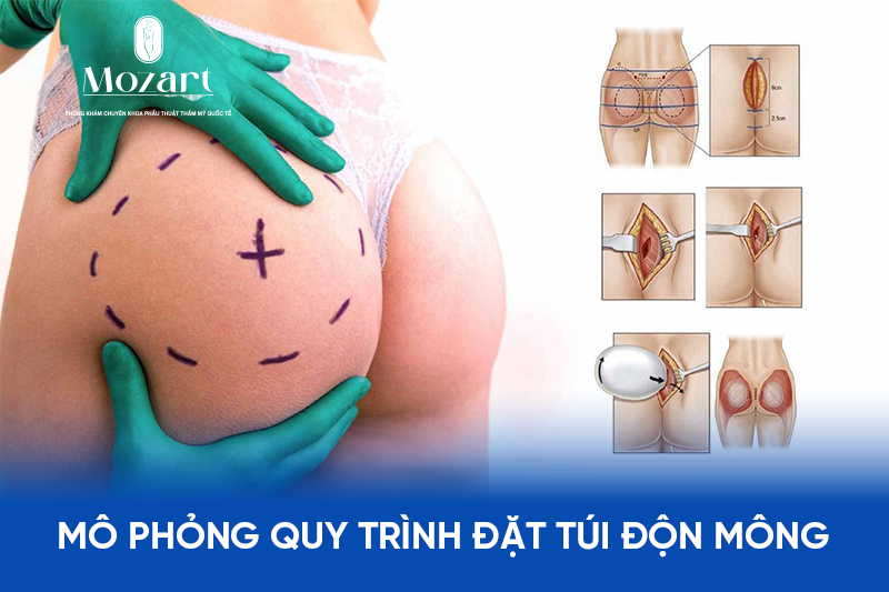 Đặt Túi Nâng Mông