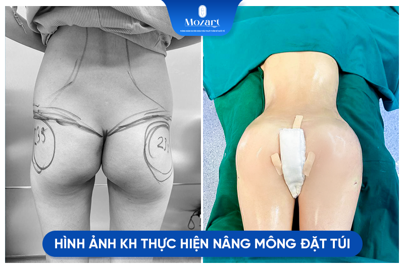 Đặt túi nâng mông