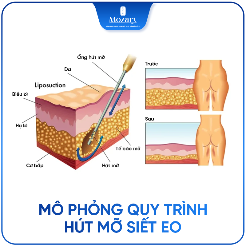 Hút mỡ siết eo
