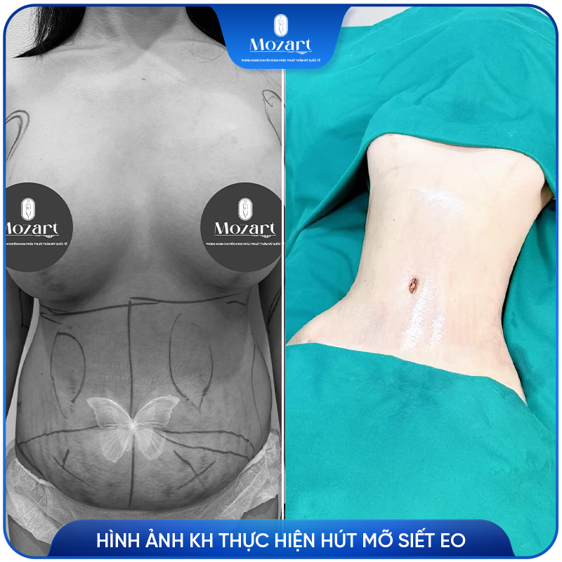 hút mỡ siết eo