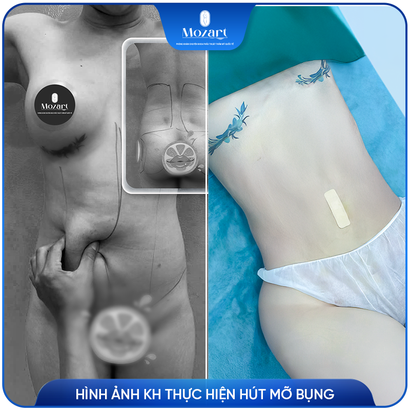 hút mỡ bụng