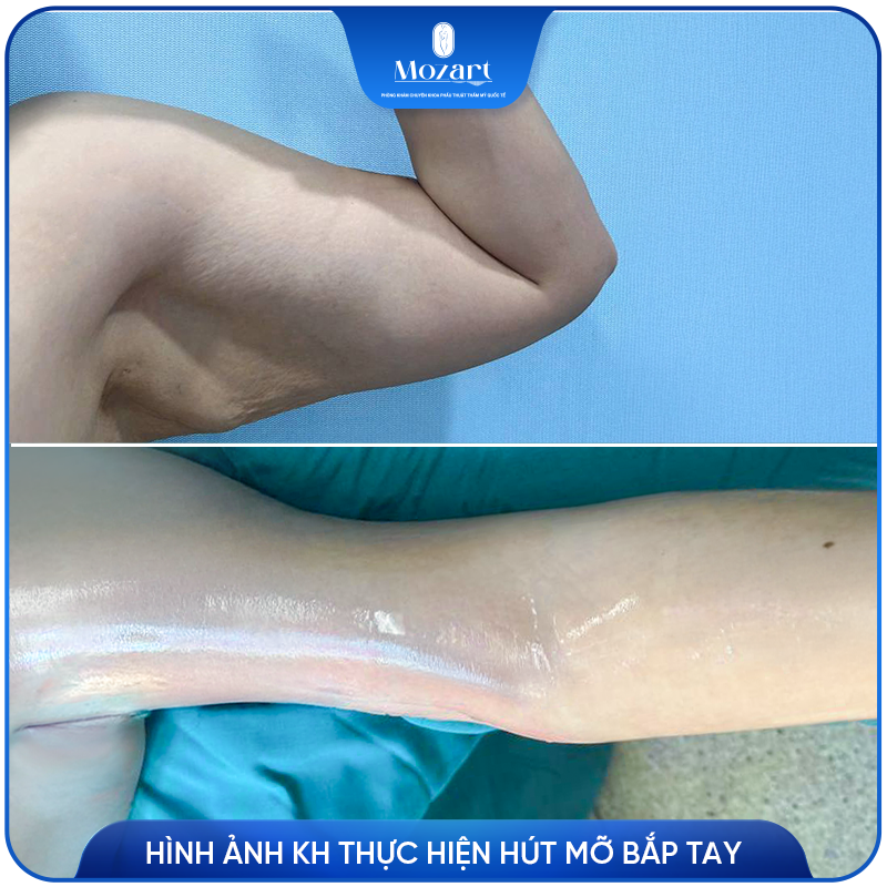 Hút mỡ tay
