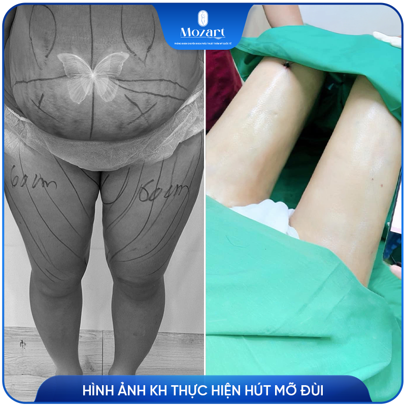 hút mỡ đùi