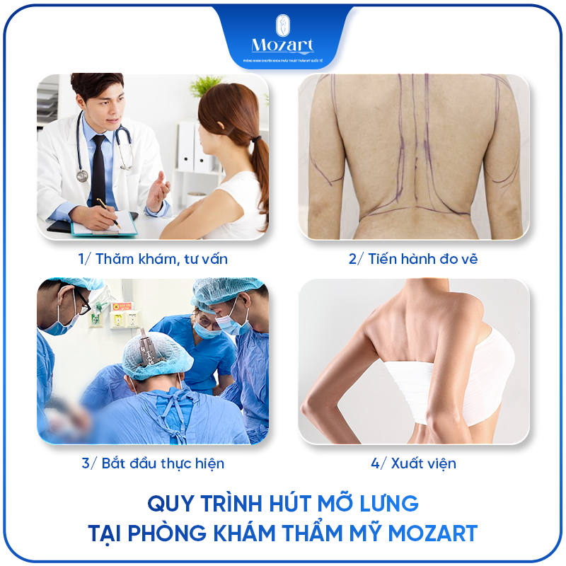 hút mỡ lưng