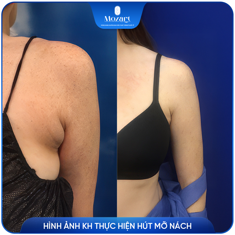 hút mỡ nách