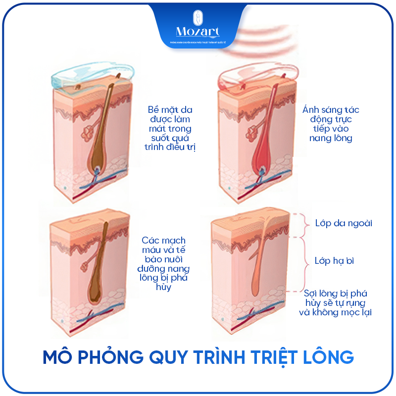 triệt lông