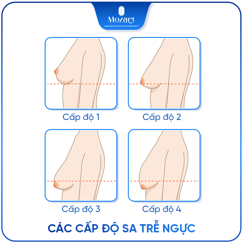 thu nhỏ ngực phì đại