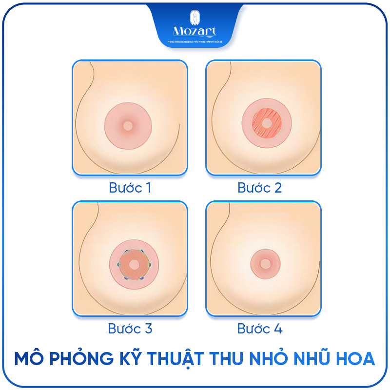 thu nhỏ nhũ hoa