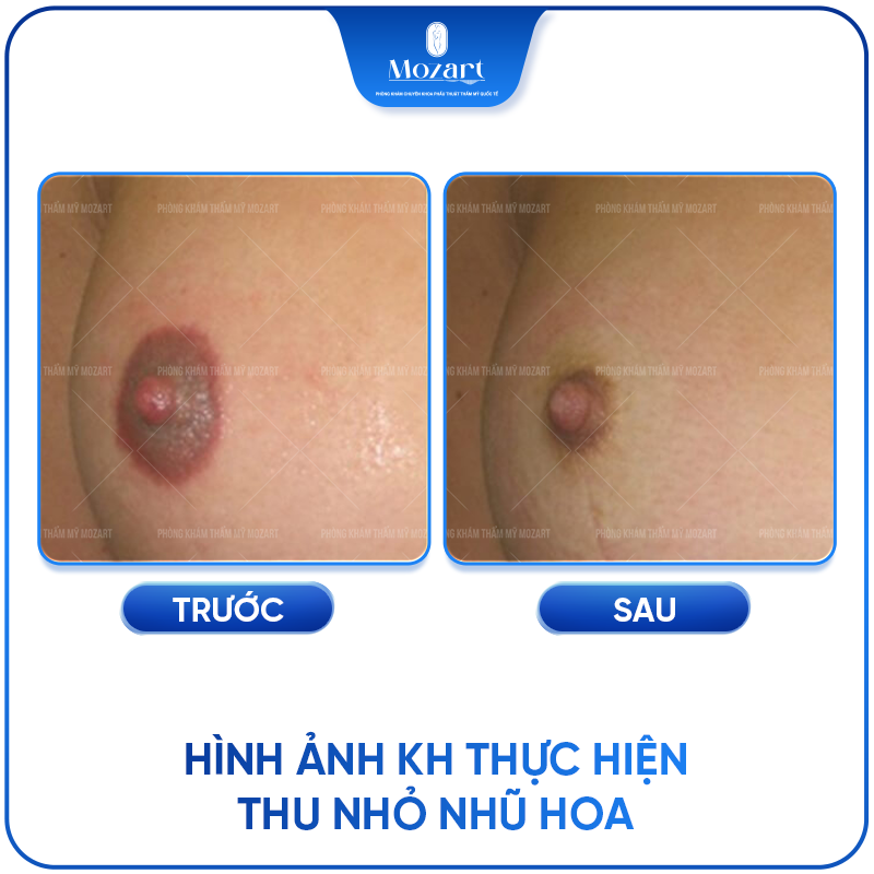 thu nhỏ nhũ hoa