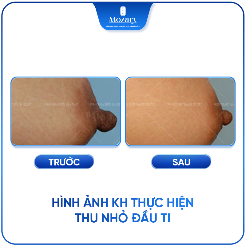thu nhỏ nhũ hoa