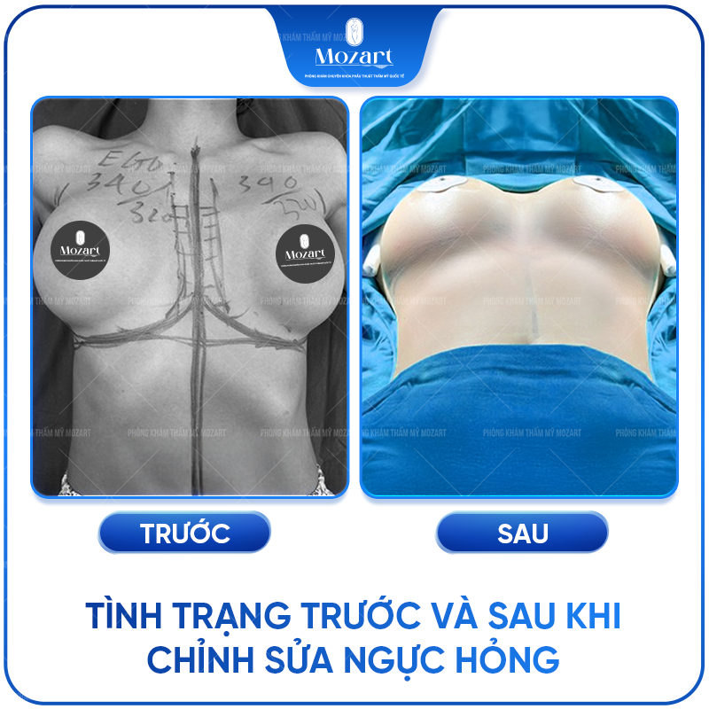 Chỉnh sửa vòng 1 hỏng
