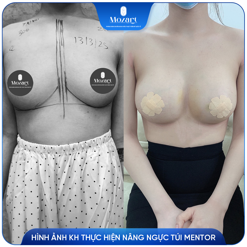 nâng ngực túi Mentor