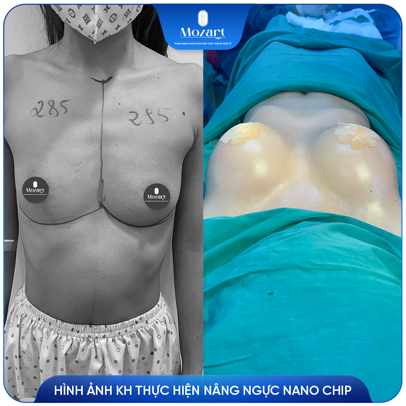 nâng ngực Nano Chip