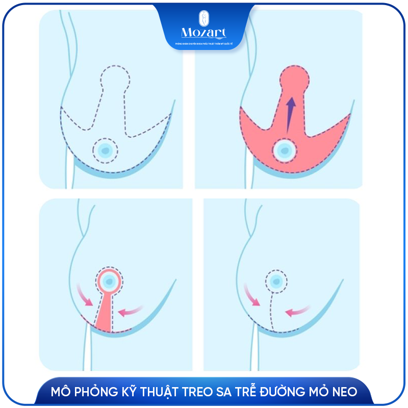 treo ngực sa trễ