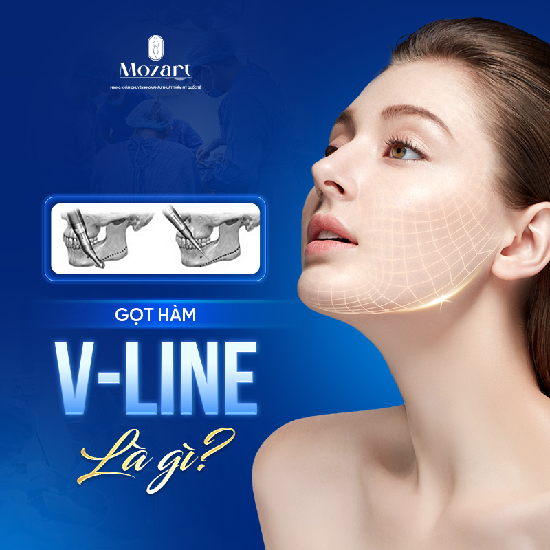 gọt hàm V Line