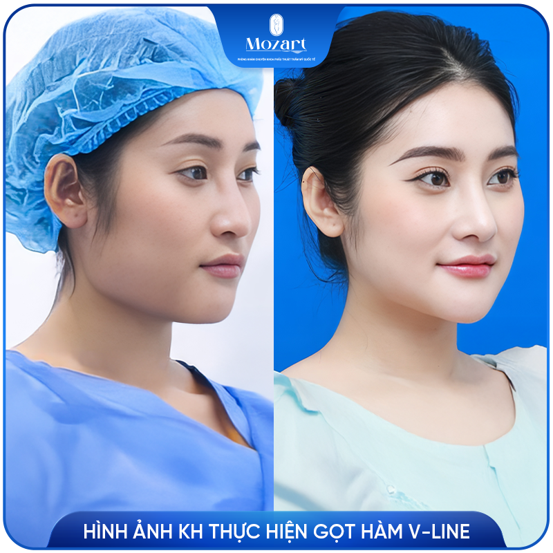 gọt hàm V Line