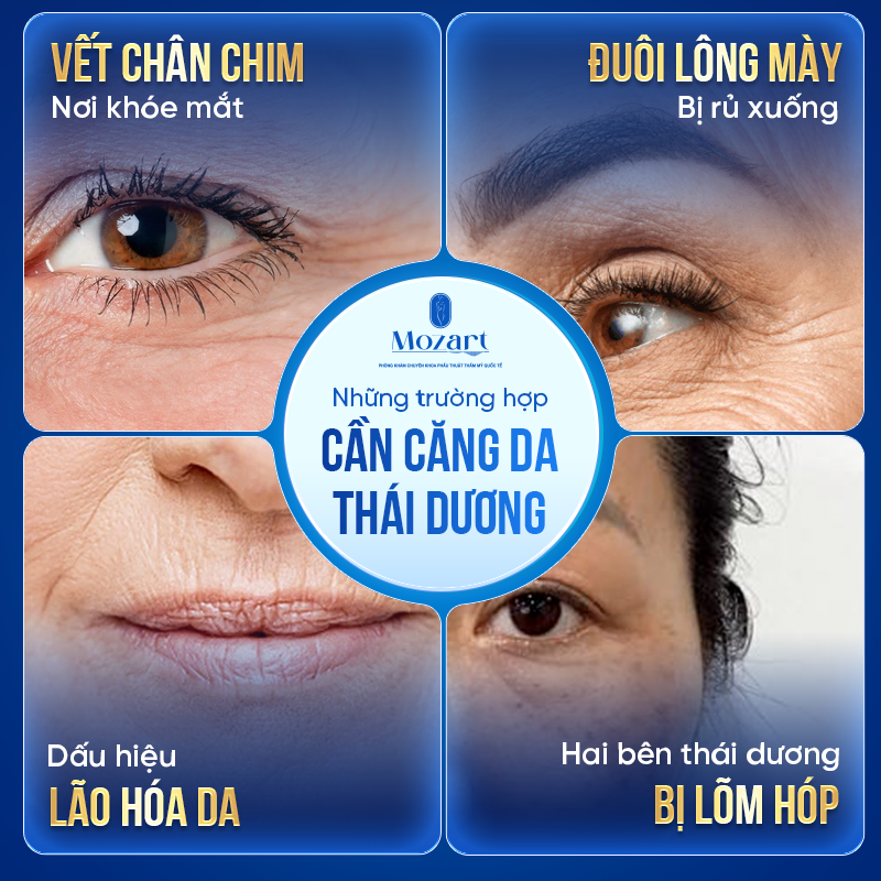 căng da thái dương