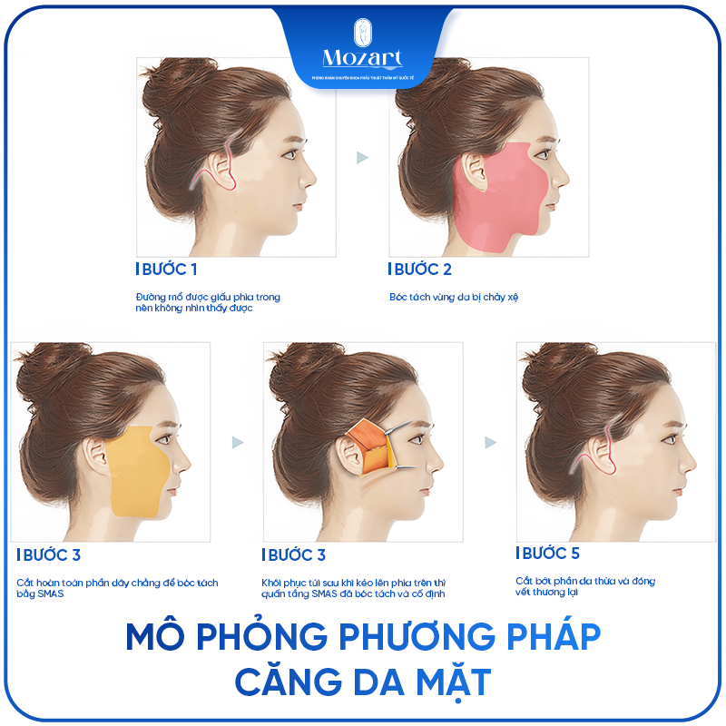 căng da mặt toàn phần