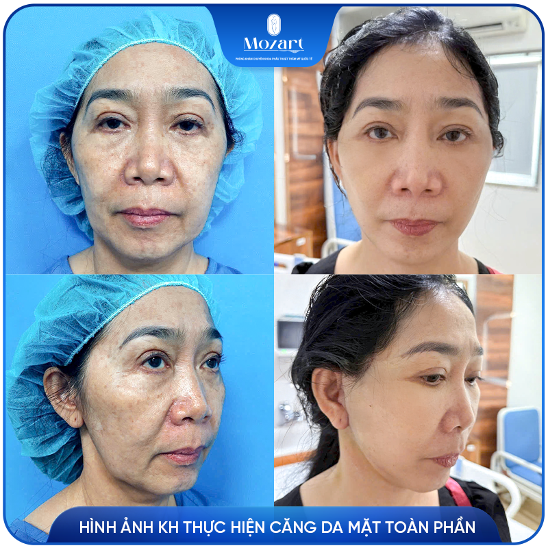 Căng da mặt toàn phần