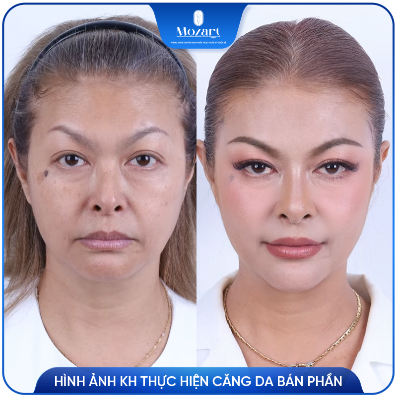 Căng da mặt bán phần