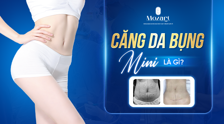 căng da bụng mini
