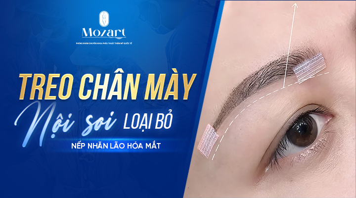 treo chân mày nội soi