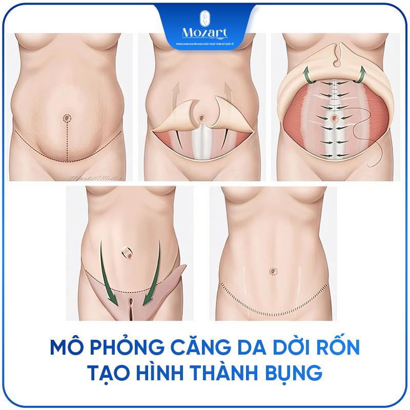 căng da bụng dời rốn tạo hình thành bụng