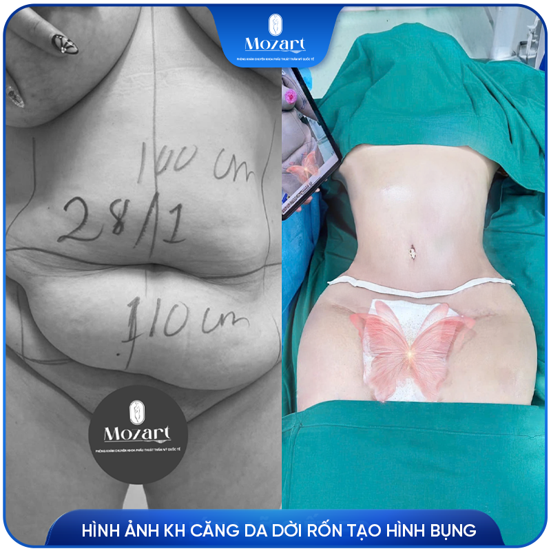 căng da bụng dời rốn tạo hình thành bụng