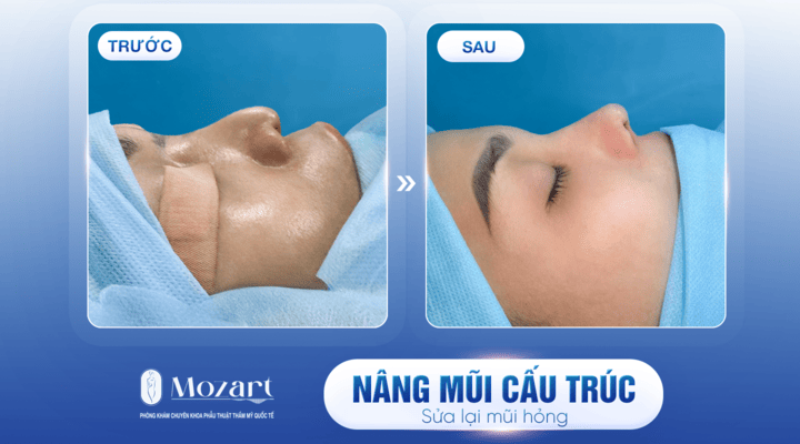 Nâng mũi cấu trúc
