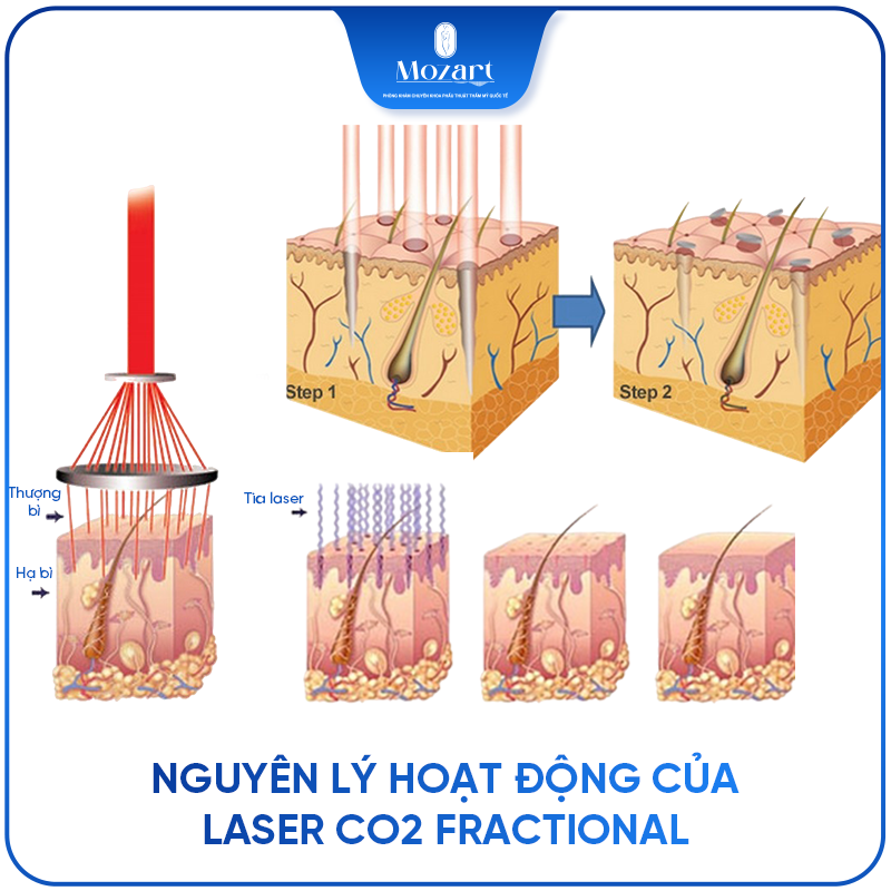 Laser CO2 Fractional