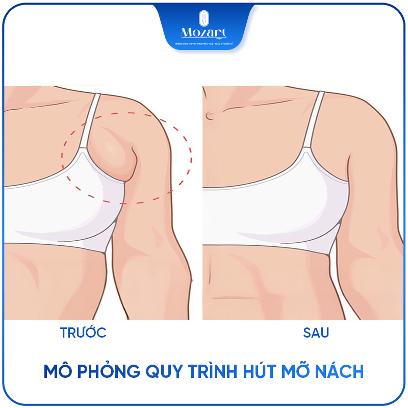 hút mỡ nách