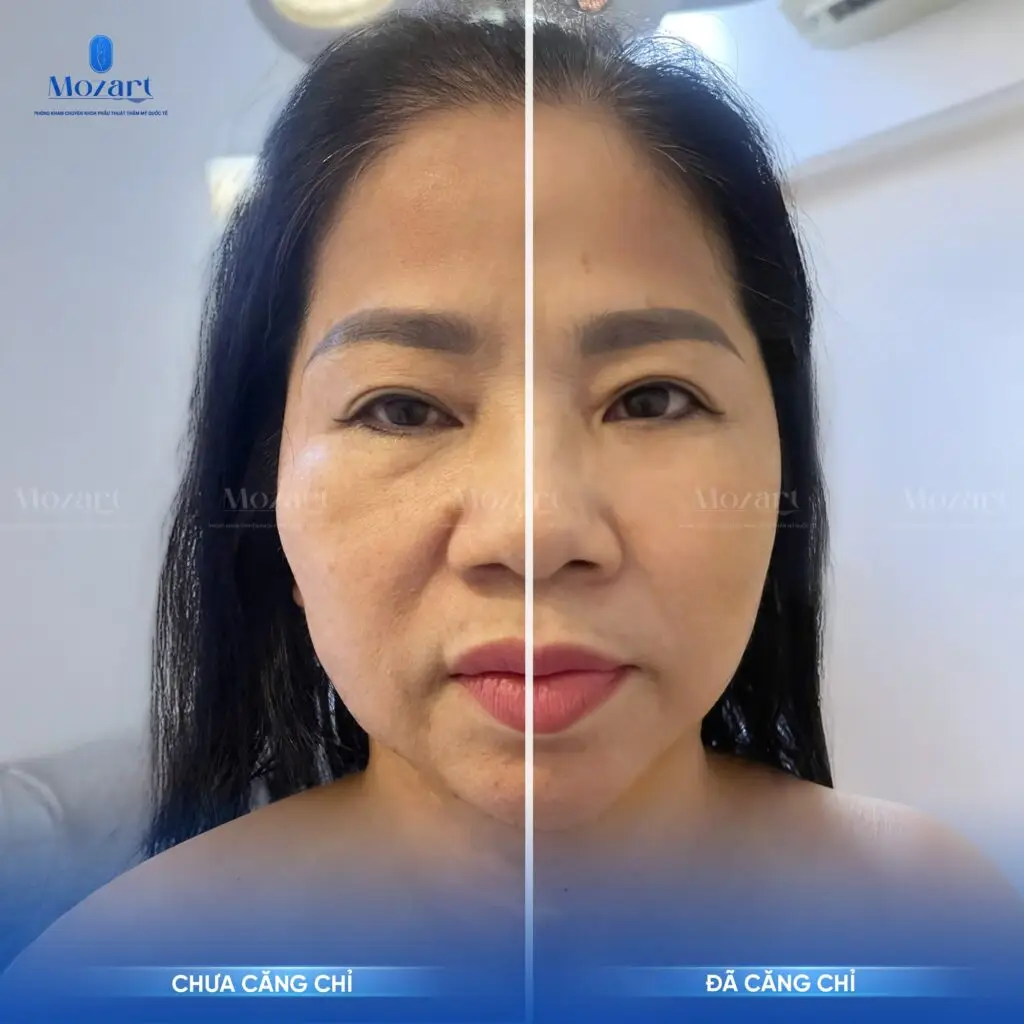 50 tuổi căng chỉ loại nào tốt